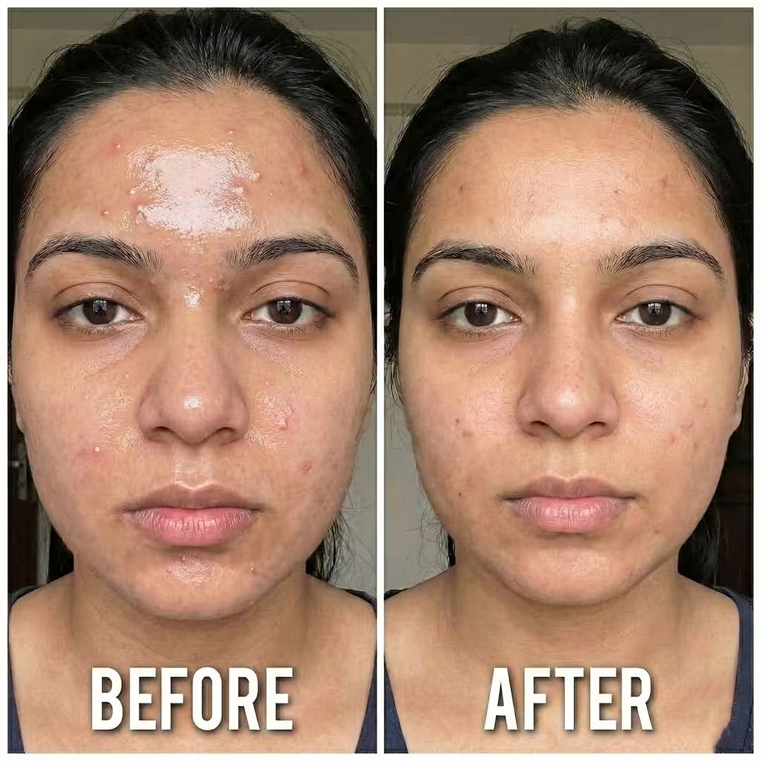 Porefect - Tea Tree Face Cream